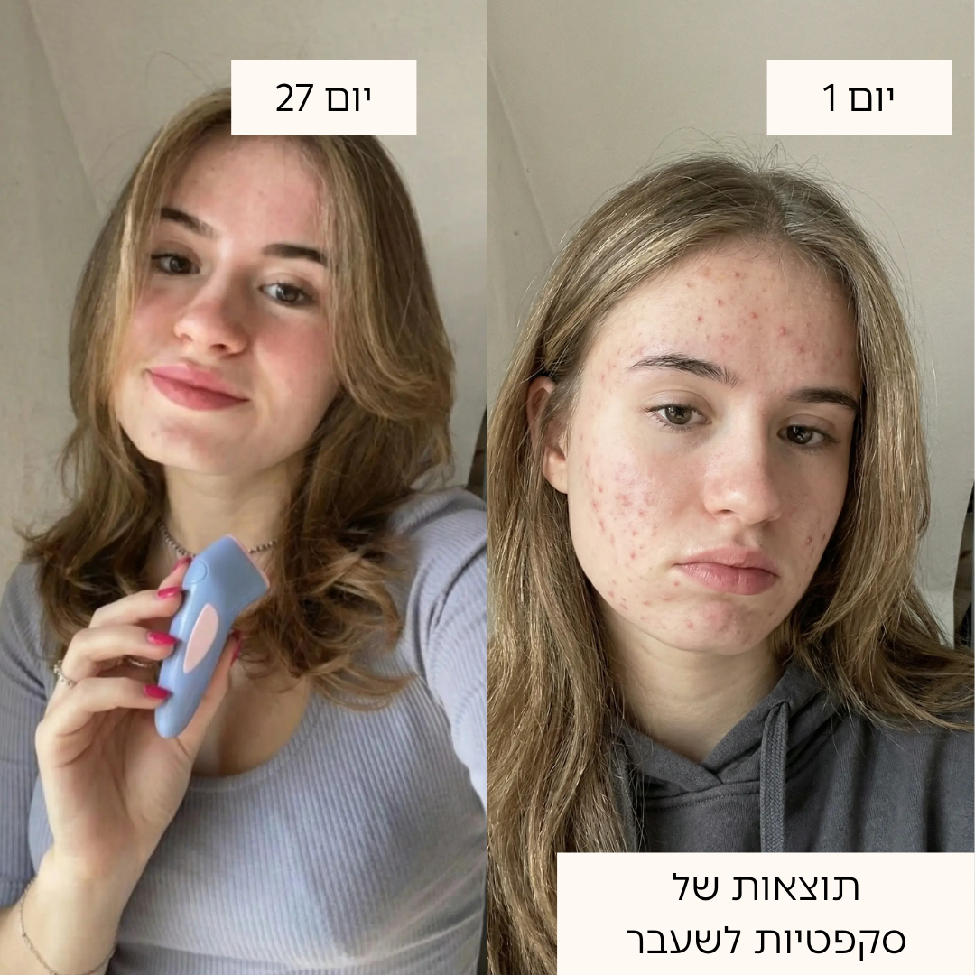 ערכת טיפול באקנה 4 ב-1 בטכנולוגיית אור כחול ואדום