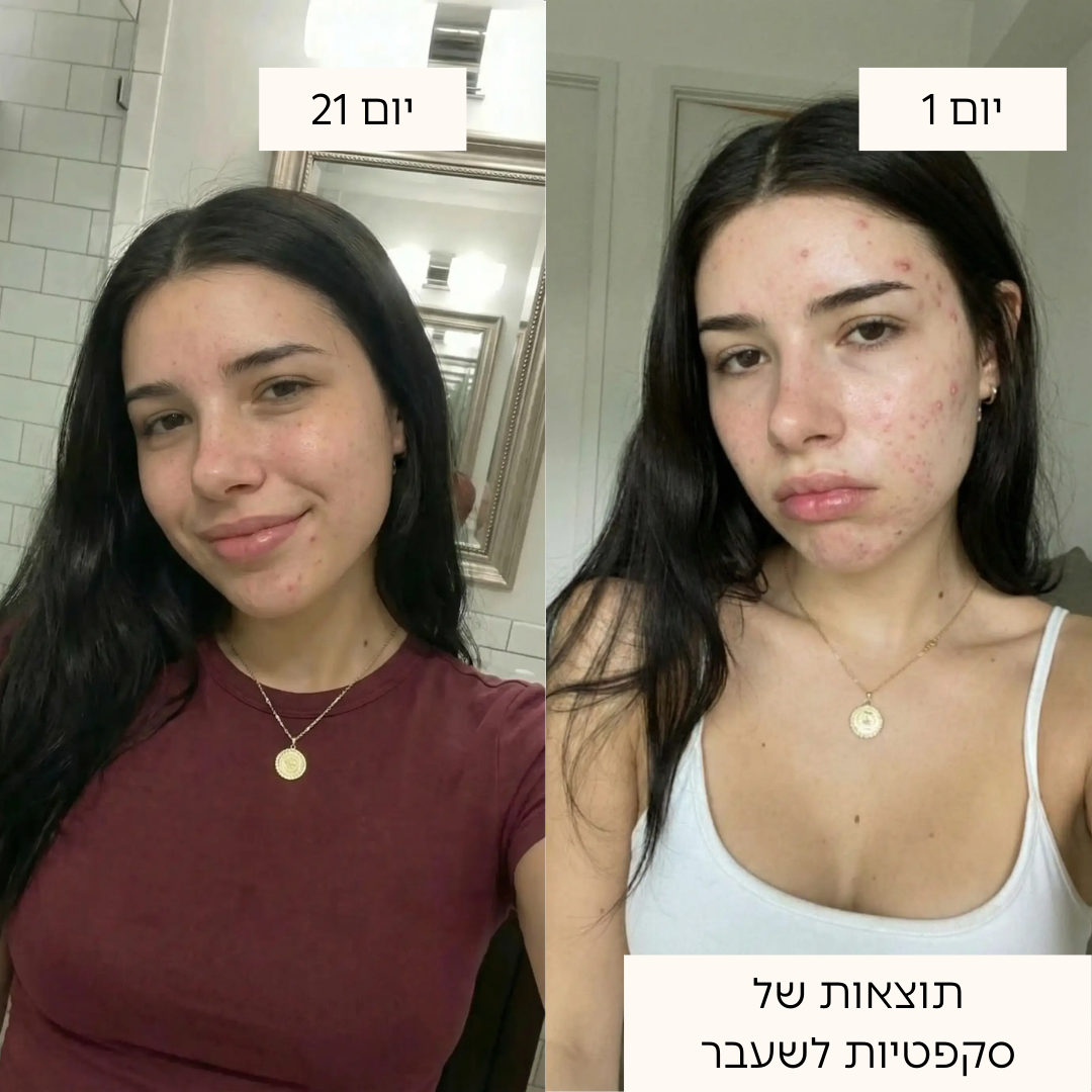 ערכת טיפול באקנה 4 ב-1 בטכנולוגיית אור כחול ואדום