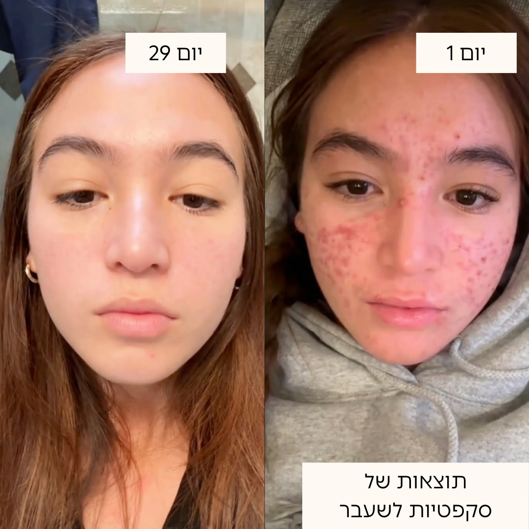 ערכת טיפול באקנה 4 ב-1 בטכנולוגיית אור כחול ואדום